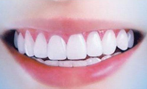 牙齿矫正有哪些危害